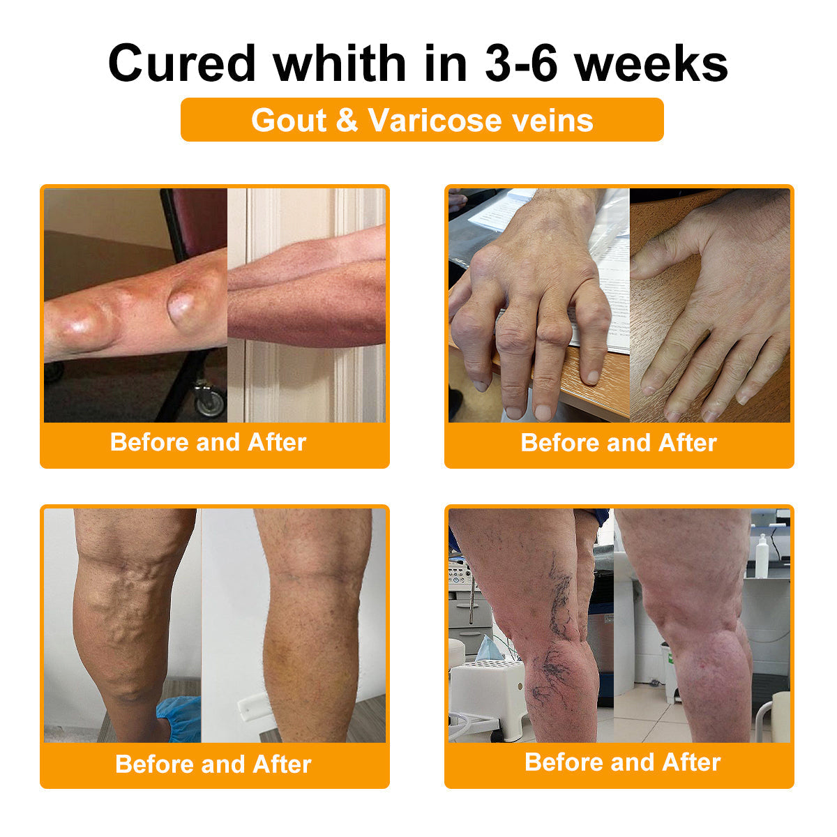 🎁Flash Sale - ODALIT™ Botulinum Toxin & Bee Venom Pain-Relief Bone Healing Cream 🐝💎