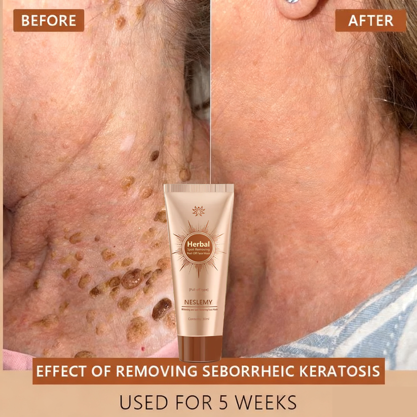 Whitening & Spot-Removing Mask – 👩‍⚕️ Natural Ingredients for Age Spots, Freckles, and Sun Spots