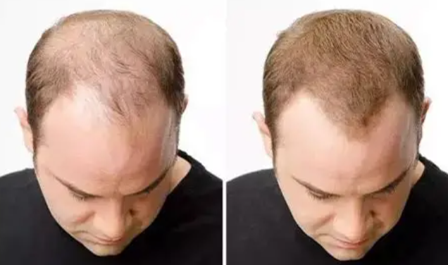 🔥 Lovilds® Hair Restoration Spray ( Reawaken Your Roots. Regrow Naturally. ✨ Clinically Proven Hair Regrowth Within 4 weeks✨)